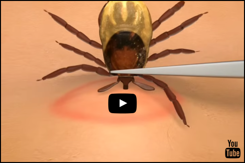 Best-Way-To-Remove-A-Tick